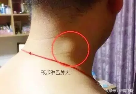 你的耳后有这种“小包”吗？不要掉以轻心呀